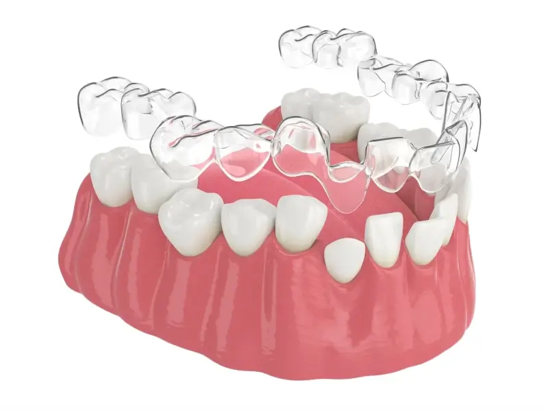 Aparat Invisalign