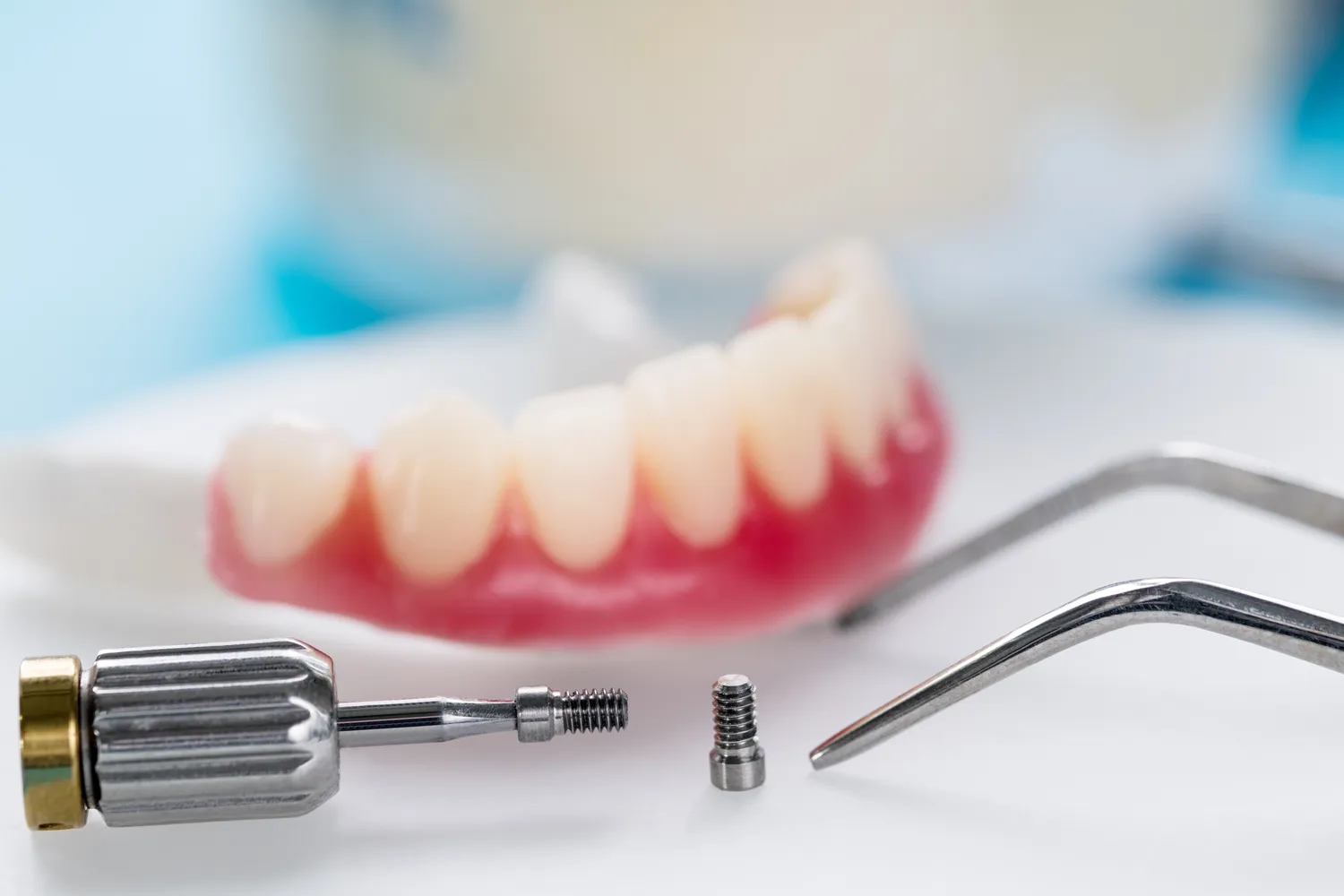 Jak wygląda zabieg wszczepiania implantów zębowych?